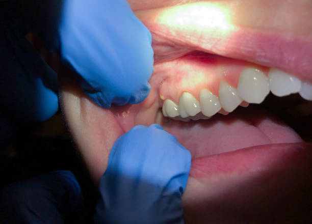 Best Emergency Root Canal Therapy in Bellows Falls, VT